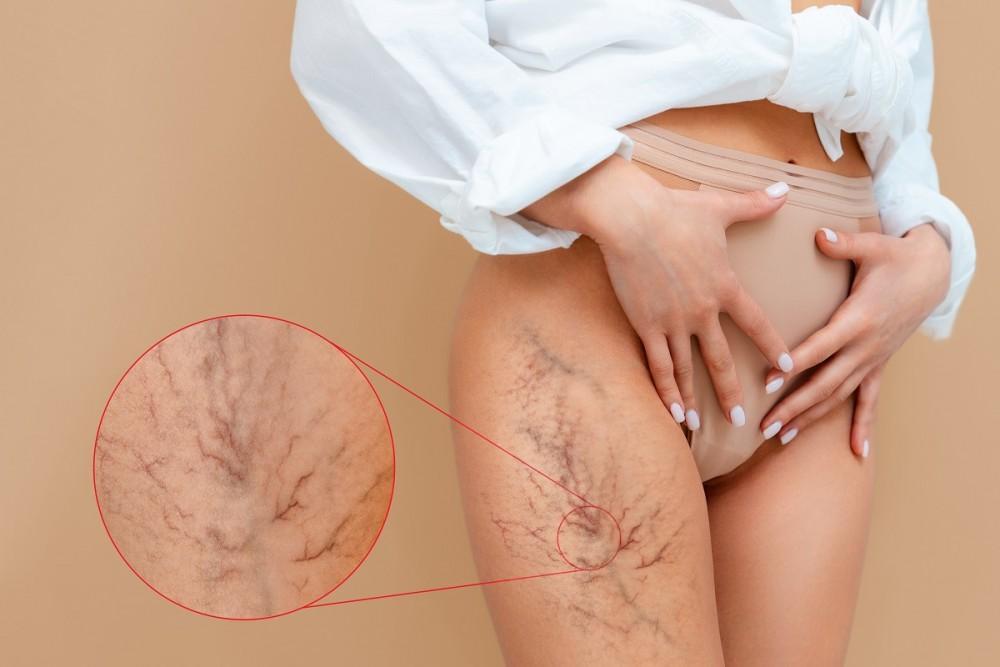 7 Cara Meningkatkan Sirkulasi Darah di Paha